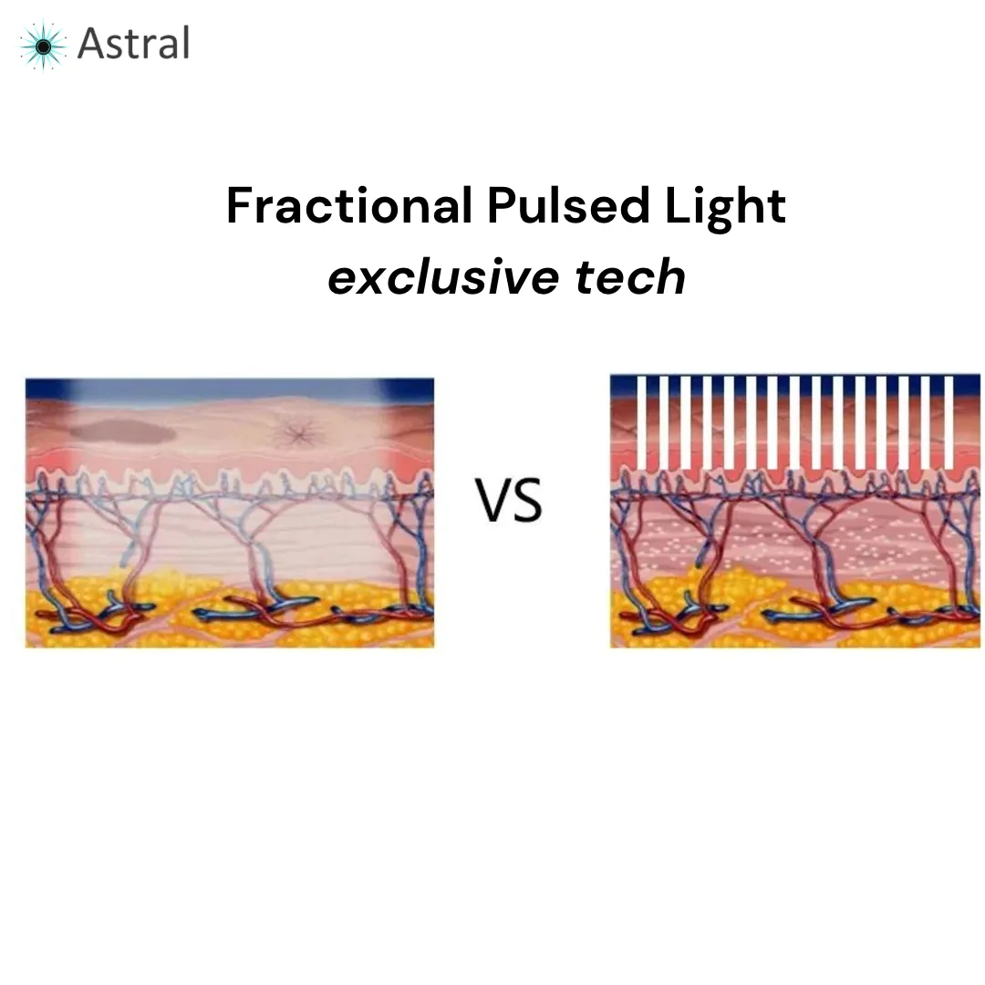 Astral F10 All-in-One Pulsed Light System- IPL   SHR   DPL   NIR   FPL